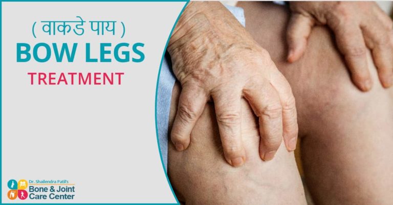 Bow-Knee-treatment