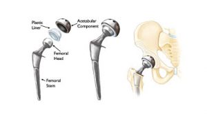 How is Hip Replacement procedure done