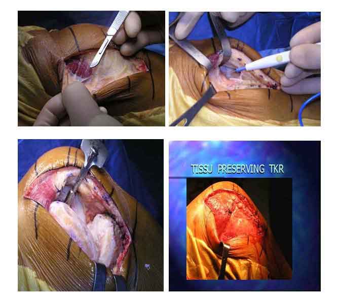Intra-operative images for subvastus approach