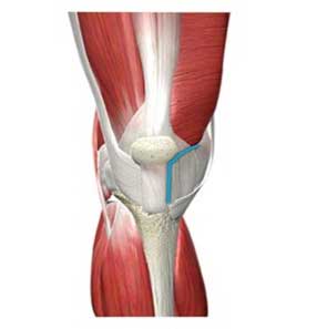 Minimally Invasive Total Knee Replacement Surgery