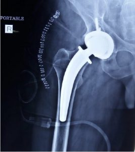 x-ray Anatomical Hip replacement