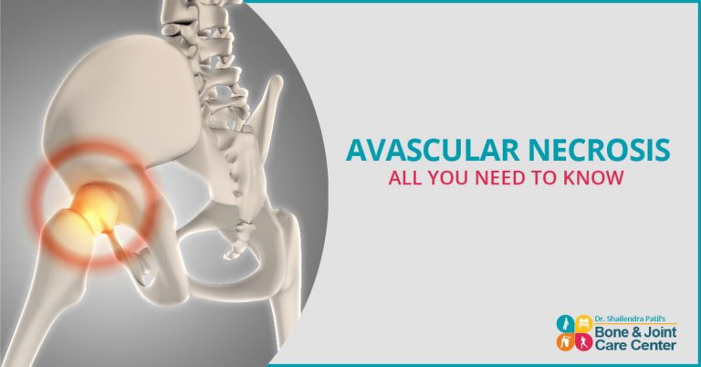 Avascular Necrosis