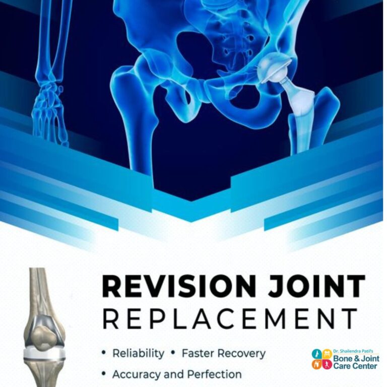 https://boneandjointcare.co.in/wp-content/uploads/2022/06/Revision-Knee-or-Hip-Replacement-Surgery-In-Thane-Mulund-768x768.jpg