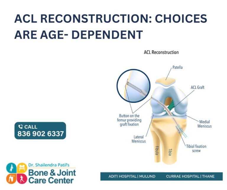 ACL Reconstruction in Thane Choices are Age- Dependent