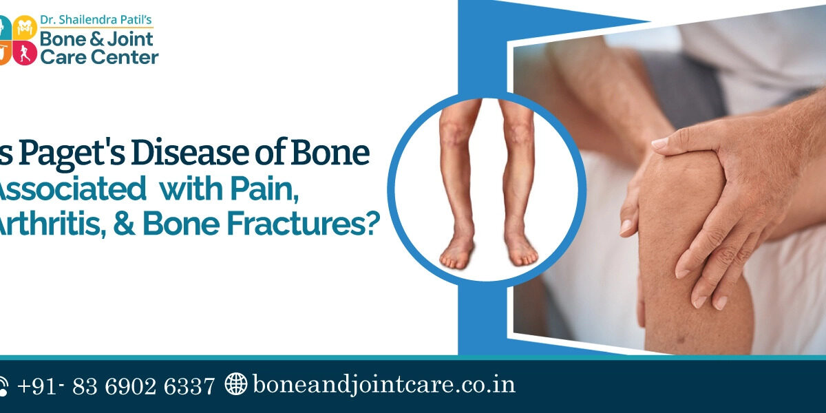 Paget Disease Of Bone- Pain, Arthritis & Bone Fractures : Bone