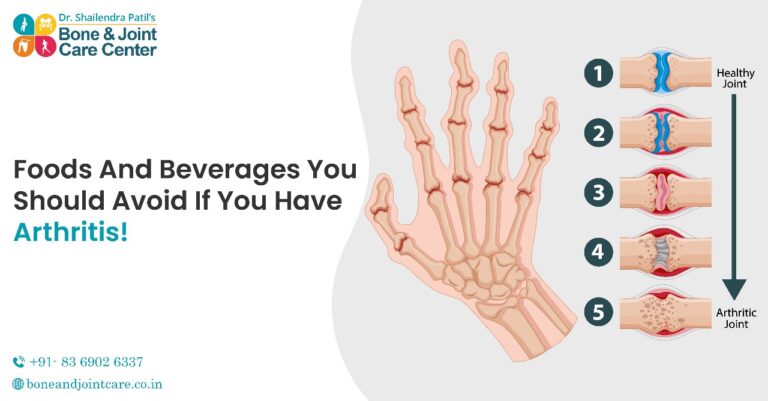 food & beverage in knee pain