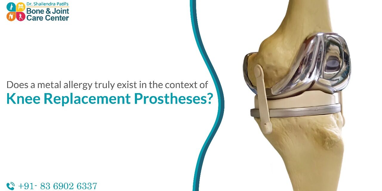 Golden Knee Replacement Surgery and the Impact of Metal Allergy on  Prosthesis Patients