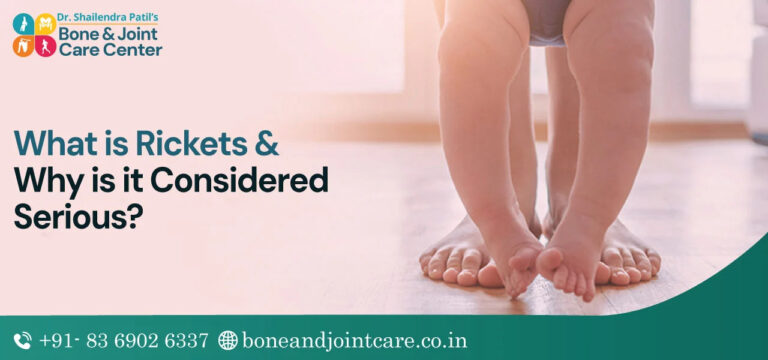 rickets orthopedic doctors for children in mumbai