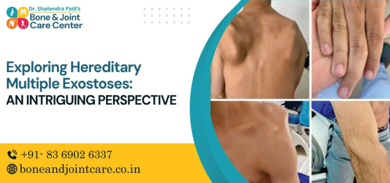 exploring hereditary multiple exostoses an intriguing perspective