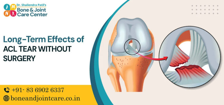 long term effects of acl tear without surgery