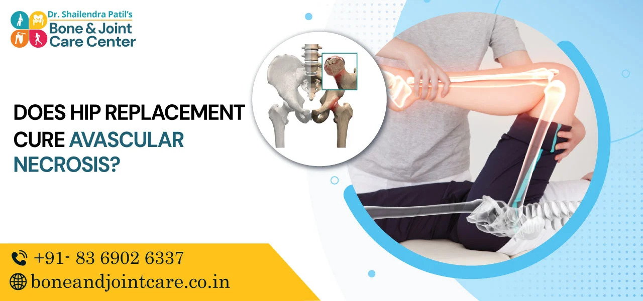 does hip replacement cure avascular necrosis