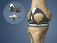 knee implants