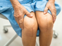 knee replacement surgery cost in Mumbai