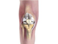 minimally invasive knee replacement surgery in mumbai