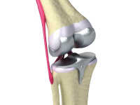 partial knee replacement surgery in mumbai