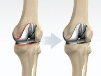 revision knee replacement surgery in mumbai