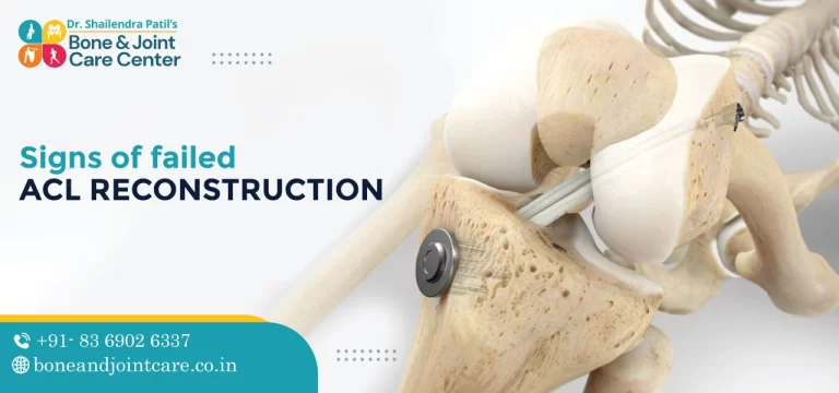 signs of failed acl reconstruction