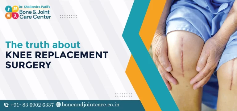 the truth about knee replacement surgery