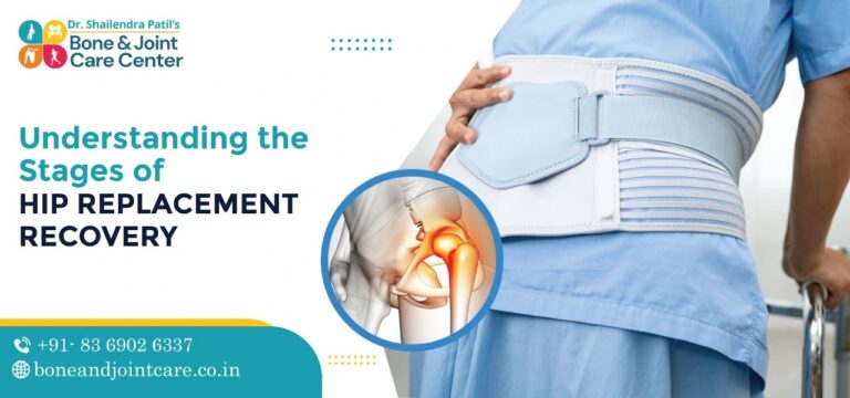 Understanding the Stages of Hip Replacement Recovery