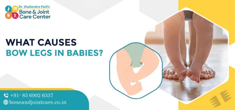 what causes bow legs in babies