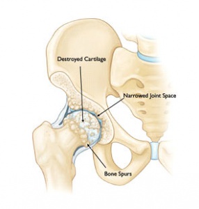 Common Causes of Hip Pain