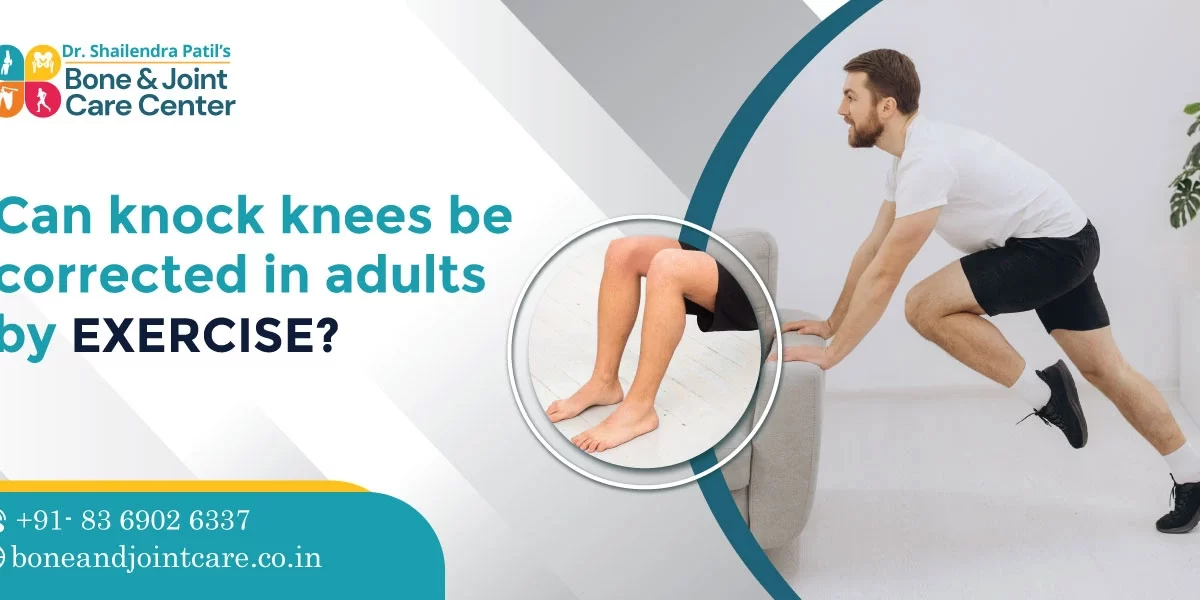 Can knock knees be corrected in adults by exercise
