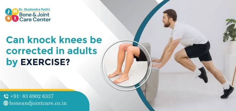 Can knock knees be corrected in adults by exercise