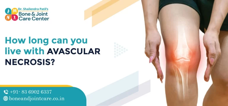how long can you live with avascular necrosis
