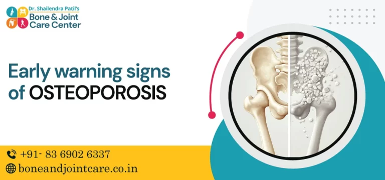 Early Warning Signs of Osteoporosis
