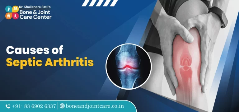 causes of septic arthritis