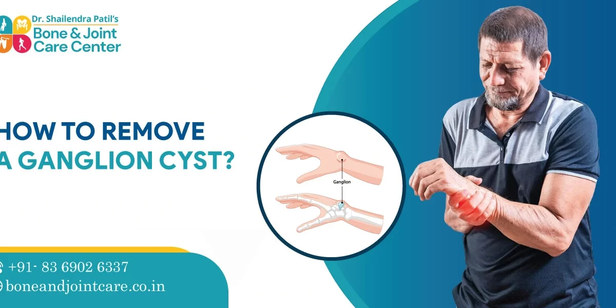 how to remove a ganglion cyst