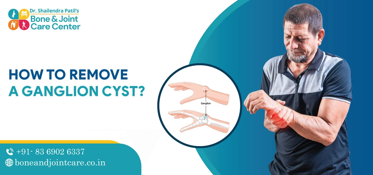 how to remove a ganglion cyst