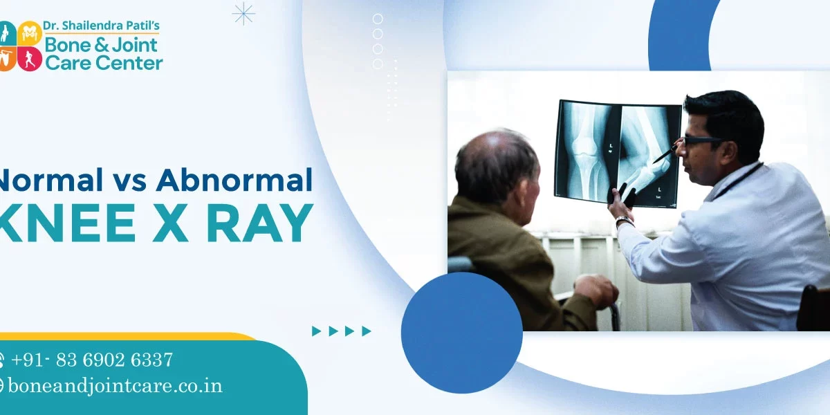 normal vs abnormal knee xray