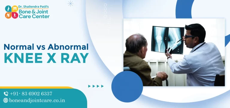 normal vs abnormal knee xray