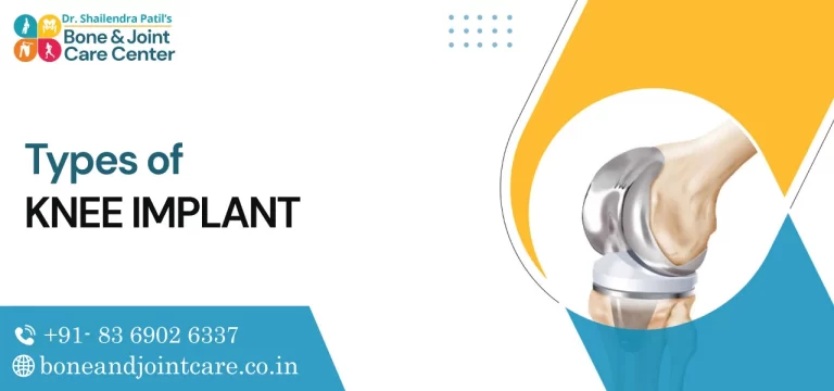 Types of Knee Implant