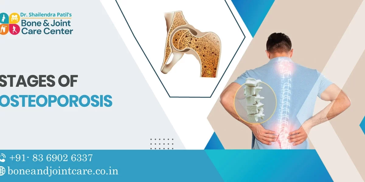 Stages of Osteoporosis