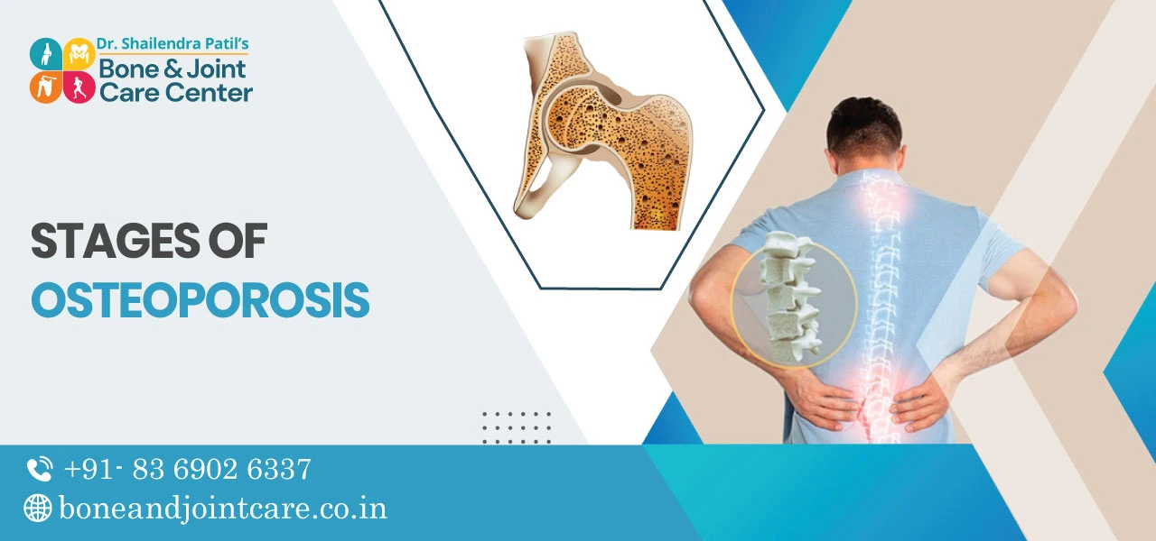 Stages of Osteoporosis