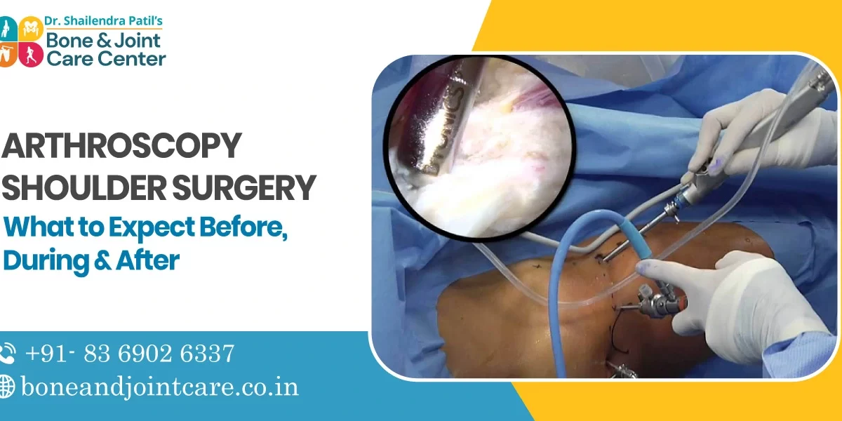 Arthroscopy Shoulder Surgery: What to Expect Before, During & After