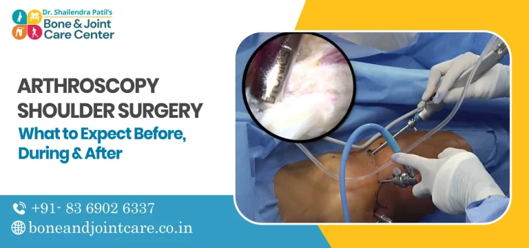 Arthroscopy Shoulder Surgery: What to Expect Before, During & After