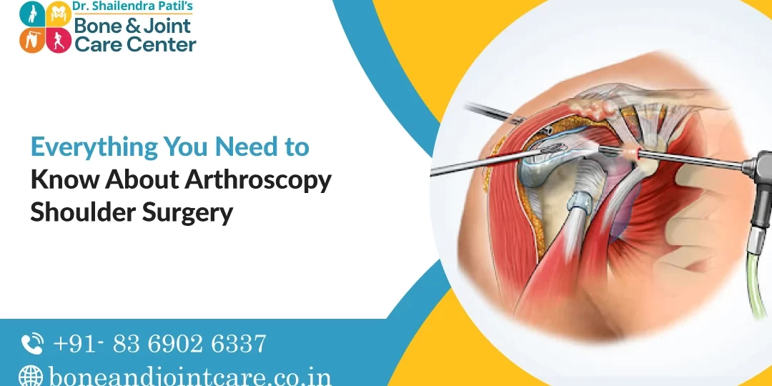 Everything You Need to Know About Arthroscopy Shoulder Surgery