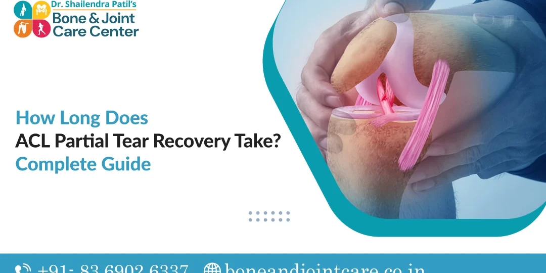How Long Does ACL Partial Tear Recovery Take?