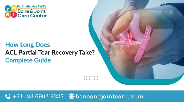 How Long Does ACL Partial Tear Recovery Take?