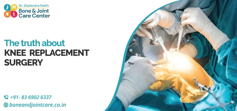 The Truth about Knee Replacement Surgery