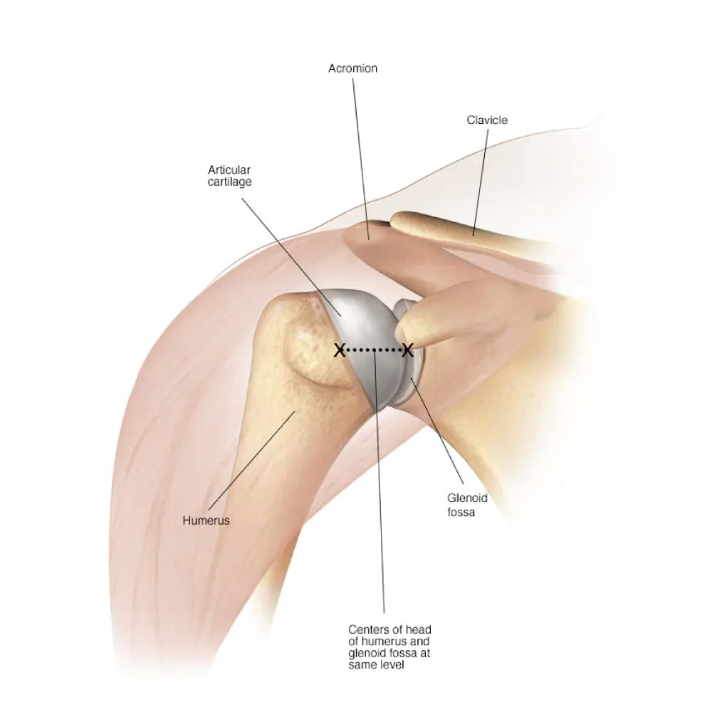 Shoulder replacement surgery