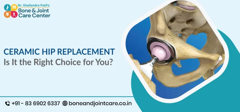 Ceramic Hip Replacement: Is It the Right Choice for You?