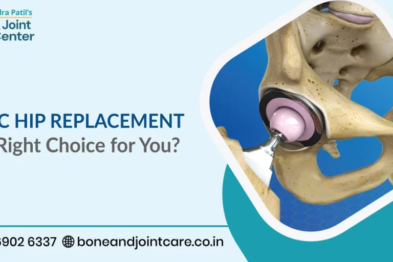 Ceramic Hip Replacement: Is It the Right Choice for You?