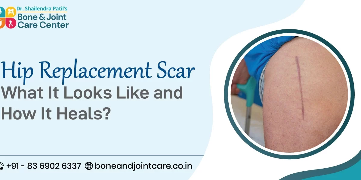 Hip Replacement Scar: What It Looks Like and How It Heals