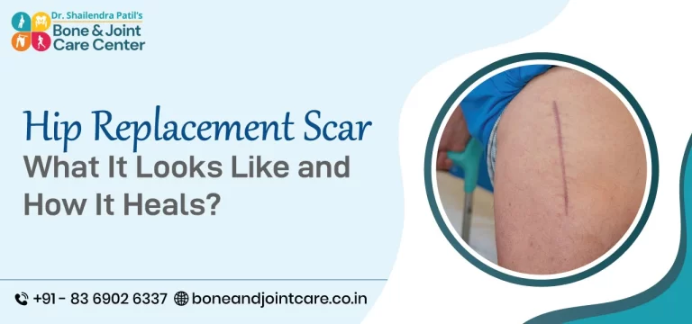 Hip Replacement Scar: What It Looks Like and How It Heals