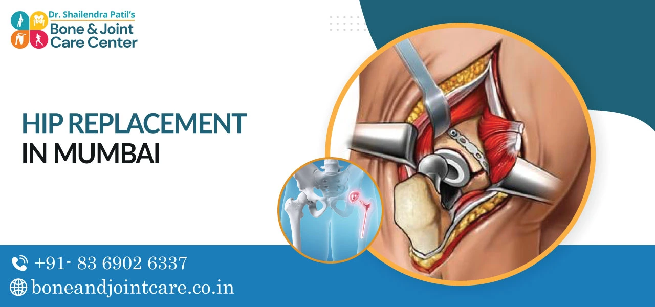 Hip Replacement in Mumbai