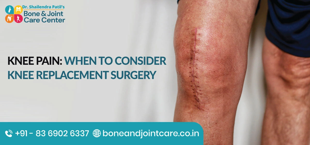 Knee Pain: When to Consider Knee Replacement Surgery